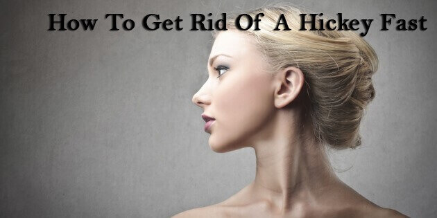 HOW TO GET RID OF A HICKEY FAST