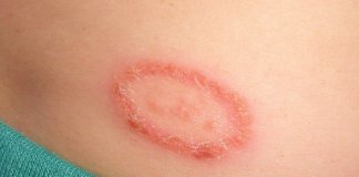 how to get rid of ringworm
