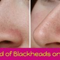blackheads on nose