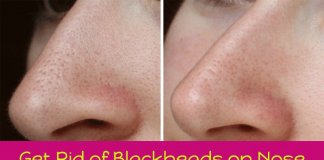 blackheads on nose