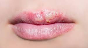 Cold Sores on Lips