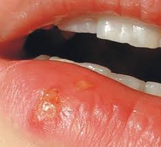 What Are The Symptoms Of Cold Sores