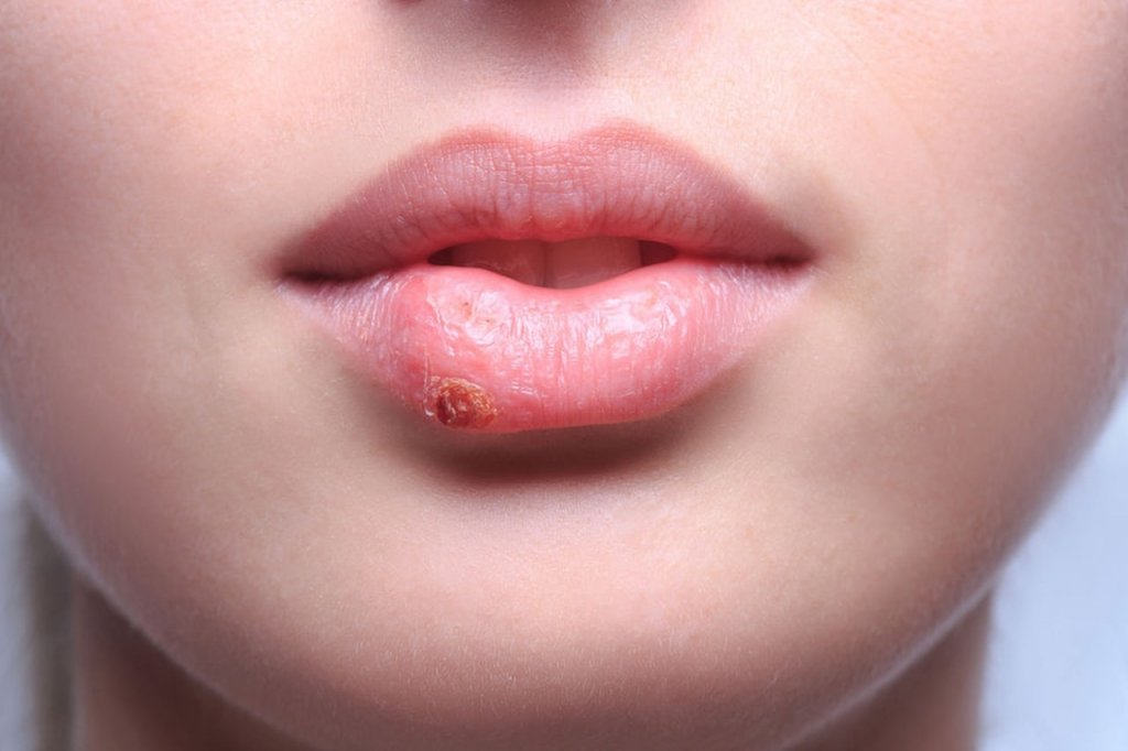 What Causes The Cold Sores