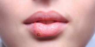 What Causes The Cold Sores