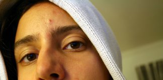 Why You Get Acne