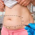 Things to Know About Coolsculpting