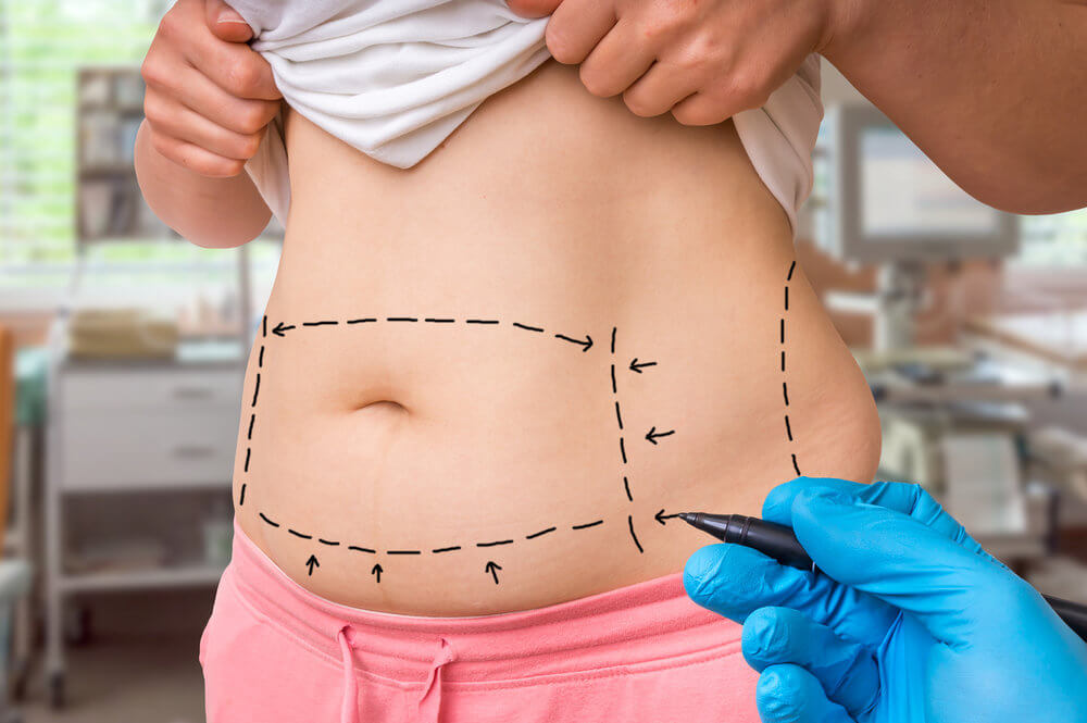 Things to Know About Coolsculpting