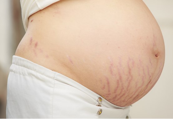 How to Get Rid of Stretch Marks