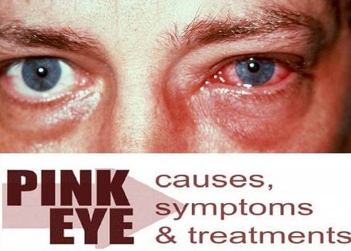 conjunctivitis treatment