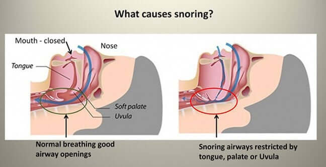 How To Stop Snoring