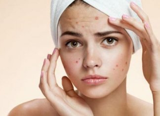 How To Get Rid Of Pimples or acne fast