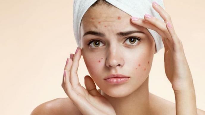 How To Get Rid Of Pimples or acne fast