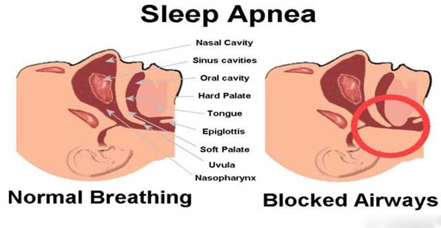 Sleep Apnea symptoms