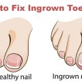 how to get rid of ingrown toenail
