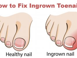 how to get rid of ingrown toenail
