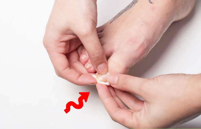 how to get rid of ingrown toenail