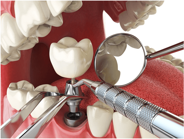 Denture Implants