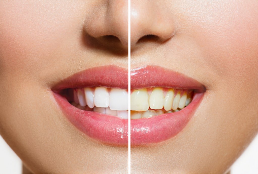 In Office vs At-Home Whitening Your Best and Brightest Smile Awaits