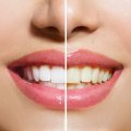 In Office vs At-Home Whitening Your Best and Brightest Smile Awaits
