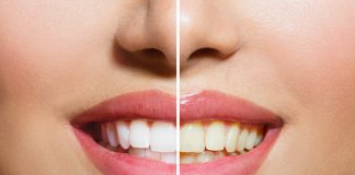 In Office vs At-Home Whitening Your Best and Brightest Smile Awaits