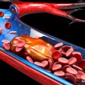 Keep it Flowing The Top Must-Know Tips to Prevent Blood Clots