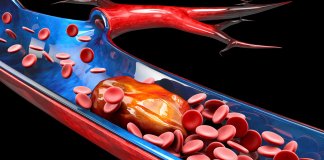 Keep it Flowing The Top Must-Know Tips to Prevent Blood Clots