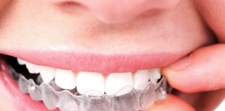 Invisalign Braces