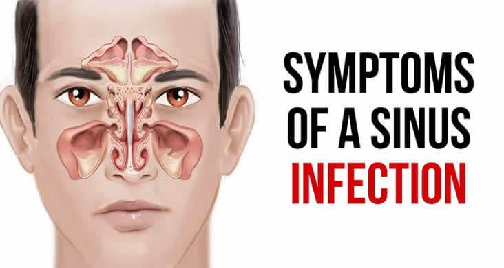 Symptoms of -Sinus-Infection