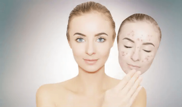 How To Get Rid Of Spots