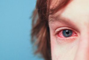 Redness in eyes