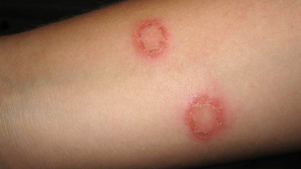 Eczema Scars