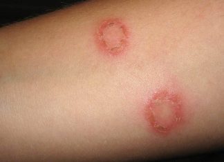 Eczema Scars
